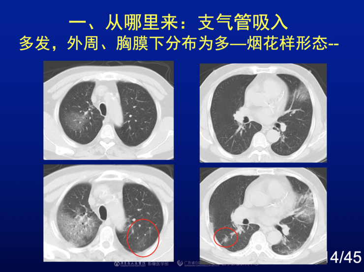新冠肺炎最早起源新疆的探讨与解析